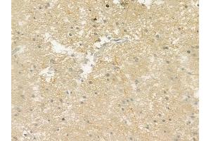 ABIN6259469 and ABIN6275467 at 1/100 staining human glioblastoma by IHC-P.