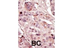 Formalin-fixed and paraffin-embedded human cancer tissue reacted with the primary antibody, which was peroxidase-conjugated to the secondary antibody, followed by AEC staining. (SRMS antibody  (N-Term))