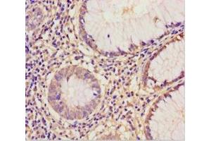 Immunohistochemistry of paraffin-embedded human colon cancer using ABIN7152221 at dilution of 1:100 (EIF6 antibody  (AA 1-245))