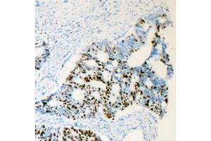 Immunohistochemical analysis of Androgen Receptor (pS650) staining in human prostate cancer formalin fixed paraffin embedded tissue section. (Androgen Receptor antibody  (pSer650))