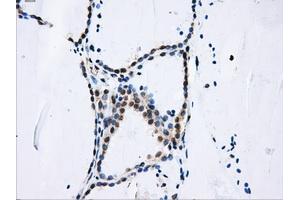 Immunohistochemical staining of paraffin-embedded liver tissue using anti-DCXRmouse monoclonal antibody. (DCXR antibody)