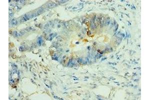 Immunohistochemistry of paraffin-embedded human colon cancer using ABIN7160825 at dilution of 1:100 (NLRP2 antibody  (AA 1-220))