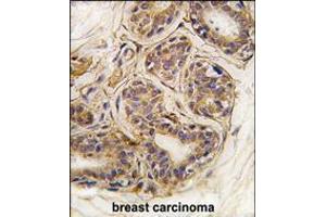 Formalin-fixed and paraffin-embedded human breast carcinoma tissue reacted with CASC3 Antibody (Y181) , which was peroxidase-conjugated to the secondary antibody, followed by DAB staining. (CASC3 antibody  (AA 159-188))
