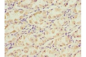 Immunohistochemistry of paraffin-embedded human gastric cancer using ABIN7149377 at dilution of 1:100 (NT5C3 antibody  (AA 37-336))