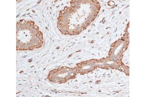 Immunohistochemistry of paraffin-embedded Human breast cancer using ABCC5 Polyclonal Antibody at dilution of 1:100 (40x lens). (ABCC5 antibody)