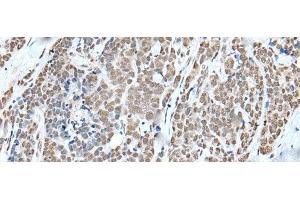 Immunohistochemistry of paraffin-embedded Human thyroid cancer tissue using WTAP Polyclonal Antibody at dilution of 1:35(x200) (WTAP antibody)