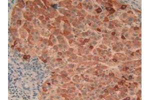 Detection of C1qA in Human Liver Cancer Tissue using Polyclonal Antibody to Complement Component 1, Q Subcomponent A (C1qA) (C1QA antibody  (AA 28-245))