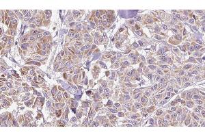 ABIN6278894 at 1/100 staining Human Melanoma tissue by IHC-P. (IL17C antibody  (Internal Region))