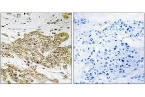 Immunohistochemistry analysis of paraffin-embedded human breast carcinoma, using p53 (Phospho-Ser6) Antibody. (p53 antibody  (pSer6))