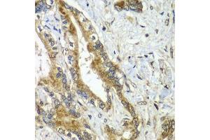Immunohistochemistry of paraffin-embedded human liver cancer using CDC16 antibody  at dilution of 1:100 (40x lens). (CDC16 antibody  (AA 371-620))