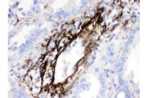 MGP was detected in paraffin-embedded sections of human lung cancer tissues using rabbit anti- MGP Antigen Affinity purified polyclonal antibody (Catalog # ) at 1 µg/mL. (MGP antibody  (AA 20-96))