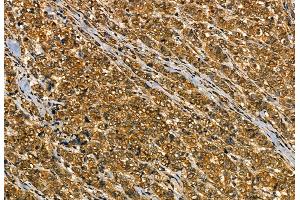 ABIN6259822 and ABIN6277769 at 1/100 staining Human breast cancer by IHC-P. (Aggrecan antibody  (N-Term))