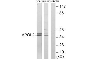 Immunohistochemistry analysis of paraffin-embedded human cervix carcinoma tissue using APOL2 antibody.
