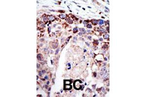 Formalin-fixed and paraffin-embedded human cancer tissue reacted with ATXN3 polyclonal antibody  , which was peroxidase-conjugated to the secondary antibody, followed by AEC staining. (Ataxin 3 antibody  (AA 29-59))