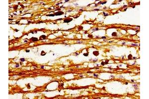 Immunohistochemistry of paraffin-embedded human melanoma using ABIN7147475 at dilution of 1:100 (CERS6 antibody  (AA 324-392))