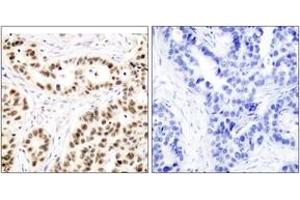 Immunohistochemistry analysis of paraffin-embedded human breast carcinoma tissue, using Elk1 (Ab-417) Antibody.