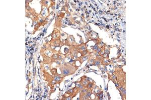 Immunohistochemistry of paraffin-embedded human lung cancer using eIF2C3 Rabbit mAb (ABIN7267039) at dilution of 1:100 (40x lens). (EIF2C3 antibody)