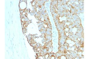 Formalin-fixed, paraffin-embedded human Colon Carcinoma stained with MAML2 Monoclonal Antibody (MAML2/1302). (MAML2 antibody)