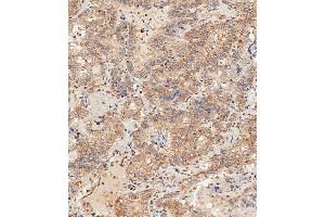 Immunohistochemical analysis of paraffin-embedded Human thyroid carcinoma tissue using B performed on the Leica® BOND RXm.