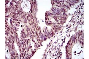 Immunohistochemical analysis of paraffin-embedded rectum cancer tissues using PIWIL4 mouse mAb with DAB staining.