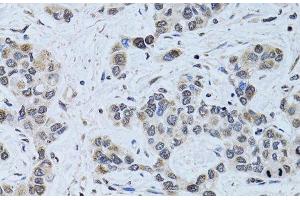 Immunohistochemistry of paraffin-embedded Human liver cancer using SIN3A Polyclonal Antibody at dilution of 1:100 (40x lens). (SIN3A antibody)