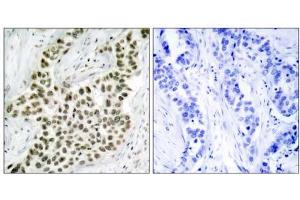 Immunohistochemical analysis of paraffin- embedded human breast carcinoma tissue using Histone H2A. (H2AFX antibody)