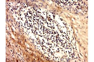 Paraformaldehyde-fixed, paraffin embedded human cervical carcinoma tissue, Antigen retrieval by boiling in sodium citrate buffer(pH6) for 15min, Block endogenous peroxidase by 3% hydrogen peroxide for 30 minutes, Blocking buffer (normal goat serum) at 37°C for 20min, Antibody incubation with Rabbit Anti-Ack1 (Tyr284) Polyclonal Antibody, Unconjugated  at 1:500 overnight at 4°C, followed by a conjugated secondary and DAB staining (TNK2 antibody  (pTyr284))