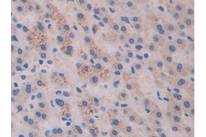 Detection of CTXI in Human Liver cancer Tissue using Monoclonal Antibody to Cross Linked C-Telopeptide Of Type I Collagen (CTXI)