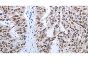 Immunohistochemistry of paraffin-embedded Human ovarian cancer tissue using RBMS1 Polyclonal Antibody at dilution 1:30 (RBMS1 antibody)