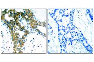 Immunohistochemical analysis of paraffin-embedded human breast carcinoma tissue, using PAK1/PAK2/PAK3 (Ab-423/402/421) antibody (E021169). (PAK1/2/3 antibody)