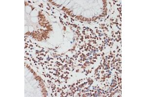 Immunohistochemistry (IHC) image for anti-Tumor Protein P53 (TP53) (pSer33) antibody (ABIN6136276)