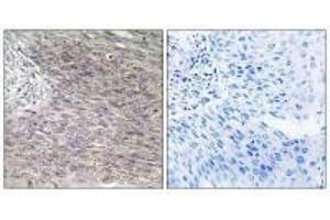 Immunohistochemistry analysis of paraffin-embedded human cervix carcinoma tissue using CHSS2 antibody. (CHPF antibody)