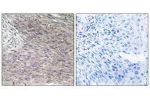 Immunohistochemistry analysis of paraffin-embedded human cervix carcinoma tissue using CHSS2 antibody. (CHPF antibody)