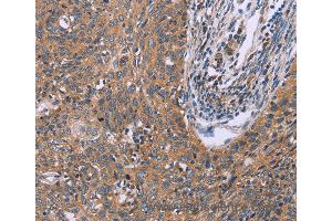 Immunohistochemistry of Human ovarian cancer using CSF2RB Polyclonal Antibody at dilution of 1:40