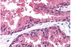 Human Prostate (formalin-fixed, paraffin-embedded) stained with LDB1 antibody ABIN214791 at 5 ug/ml followed by biotinylated goat anti-rabbit IgG secondary antibody ABIN481713, alkaline phosphatase-streptavidin and chromogen. (LIM Domain Binding 1 Protein antibody  (AA 303-352))