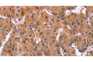 Immunohistochemistry of paraffin-embedded Human liver cancer using ERP29 Polyclonal Antibody at dilution of 1:40