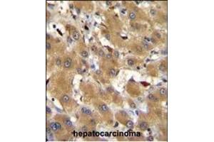 HPR Antibody (Center) (ABIN655063 and ABIN2844693) immunohistochemistry analysis in formalin fixed and paraffin embedded human hepatocarcinoma followed by peroxidase conjugation of the secondary antibody and DAB staining.