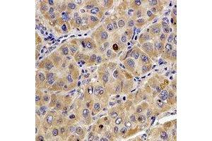 Immunohistochemical analysis of Tropomodulin-4 staining in human liver cancer formalin fixed paraffin embedded tissue section. (Tropomodulin 4 antibody)