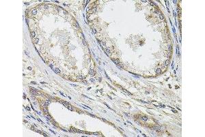 Immunohistochemistry of paraffin-embedded Human prostate cancer using UBE2S Polyclonal Antibody at dilution of 1:100 (40x lens). (UBE2S antibody)