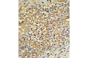 UDB17 Antibody (Center) (ABIN390399 and ABIN2840791) IHC analysis in formalin fixed and paraffin embedded human Prostate carcinoma followed by peroxidase conjugation of the secondary antibody and DAB staining. (UGT2B17 antibody  (AA 119-147))