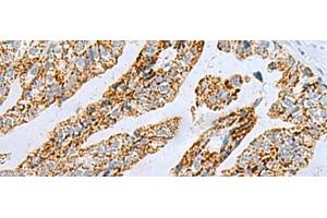 Immunohistochemistry of paraffin-embedded Human gastric cancer tissue using PYCR2 Polyclonal Antibody at dilution of 1:40(x200) (PYCR2 antibody)