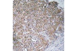 Immunohistochemical analysis of CHST13 staining in human liver cancer formalin fixed paraffin embedded tissue section.