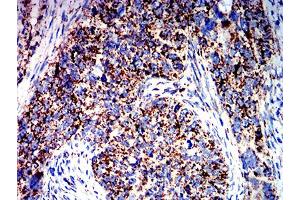 Immunohistochemical analysis of paraffin-embedded cervical cancer tissues using ATPIF1 mouse mAb with DAB staining. (ATPase Inhibitory Factor 1 antibody  (AA 1-106))