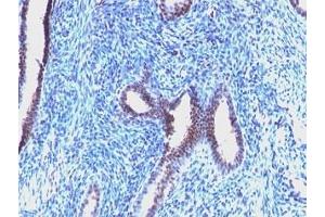 Formalin-fixed, paraffin-embedded human endometrial carcinoma stained with Cyclin B1 antibody (CCNB1/1098). (Cyclin B1 antibody)
