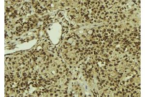ABIN6279887 at 1/100 staining Human breast cancer tissue by IHC-P. (SART1 antibody  (C-Term))