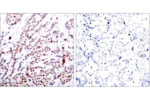 Immunohistochemistry analysis of paraffin-embedded human breast carcinoma, using ATF2 (Phospho-Thr73 or 55) Antibody.