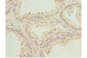 Immunohistochemistry of paraffin-embedded human prostate cancer using ABIN7156132 at dilution of 1:100 (KPNA6 antibody  (AA 277-536))