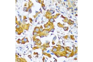 Immunohistochemistry of paraffin-embedded human lung cancer using AARS antibody (ABIN7265526) at dilution of 1:100 (40x lens). (AARS antibody  (AA 1-100))