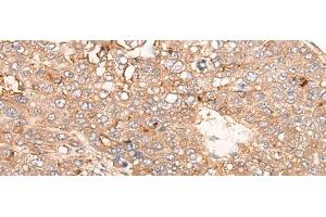 Immunohistochemistry of paraffin-embedded Human liver cancer tissue using SIGLECL1 Polyclonal Antibody at dilution of 1:65(x200)