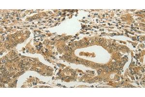 Immunohistochemistry of paraffin-embedded Human gastric cancer using MYSM1 Polyclonal Antibody at dilution of 1:60 (MYSM1 antibody)